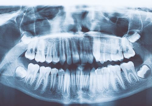 Are Dental X-Rays Safe_1