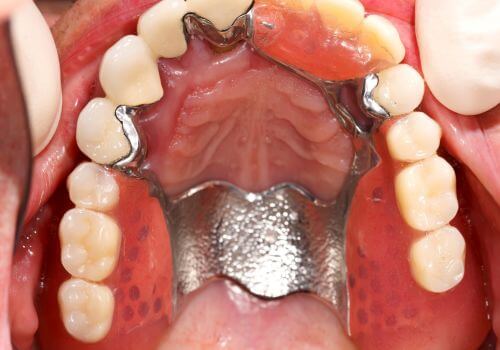 Caring for Your Dental Bridge