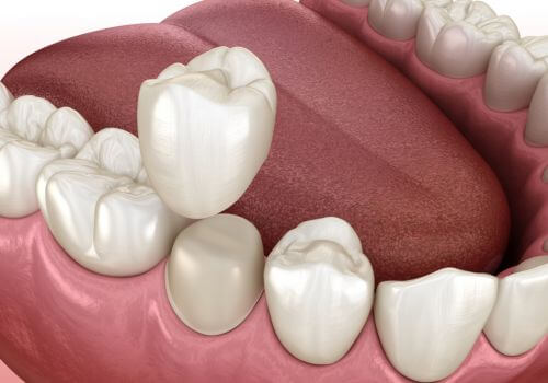 Caring for Your Dental Crown_1