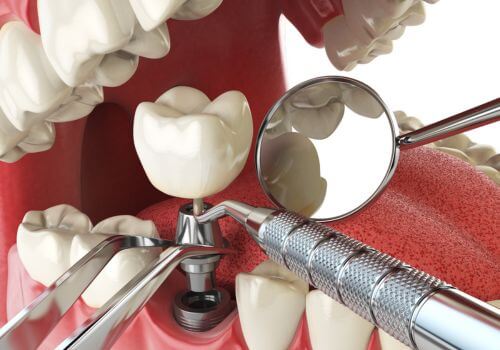 Choosing the right Dental1