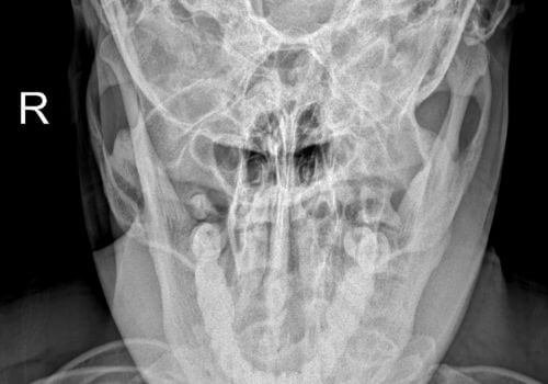 Dens Invaginatus