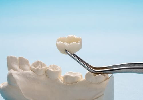 Dental Crown Myths_2