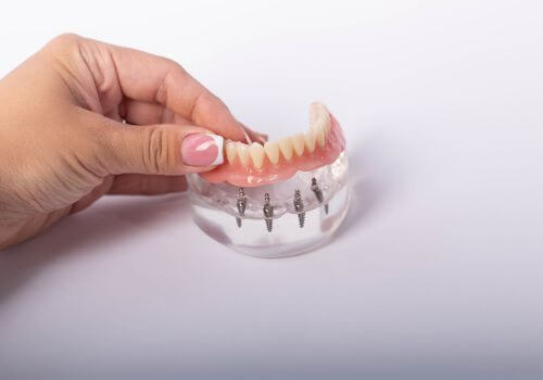 Implant-Supported Dentures_1