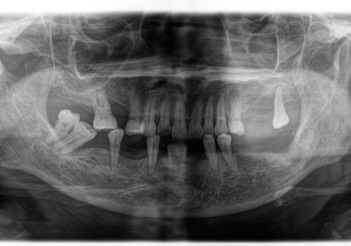 Regional Odontodysplasia_2