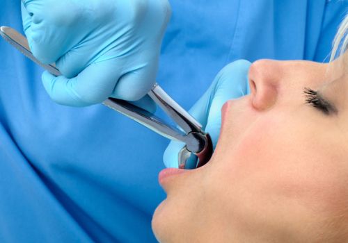 Tooth Extraction and Aftercare