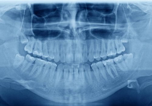 Types of Dental X-Rays