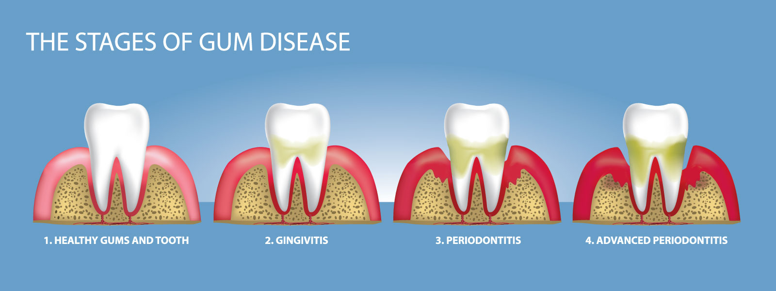 Stages of gum disease